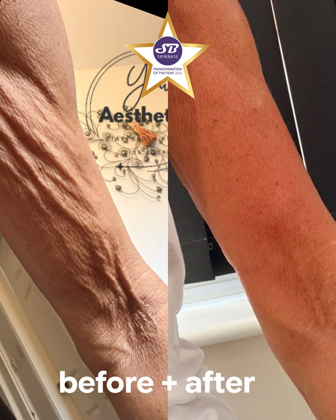  before and after you aesthetics arms